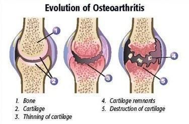 osteoarthritis knee