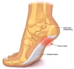 How-to-treat-plantar-fasciitis.jpg